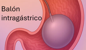 Balón intragástrico